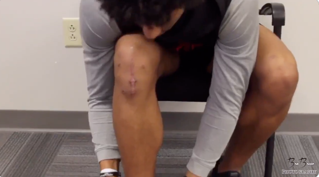 kamryn babb's right knee and first torn ACL