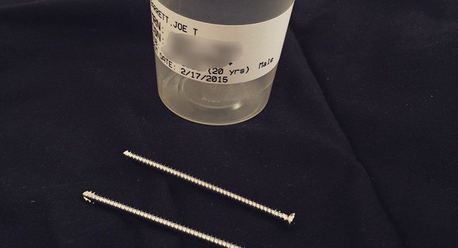 The two screws that were removed from J.T. Barrett's ankle.